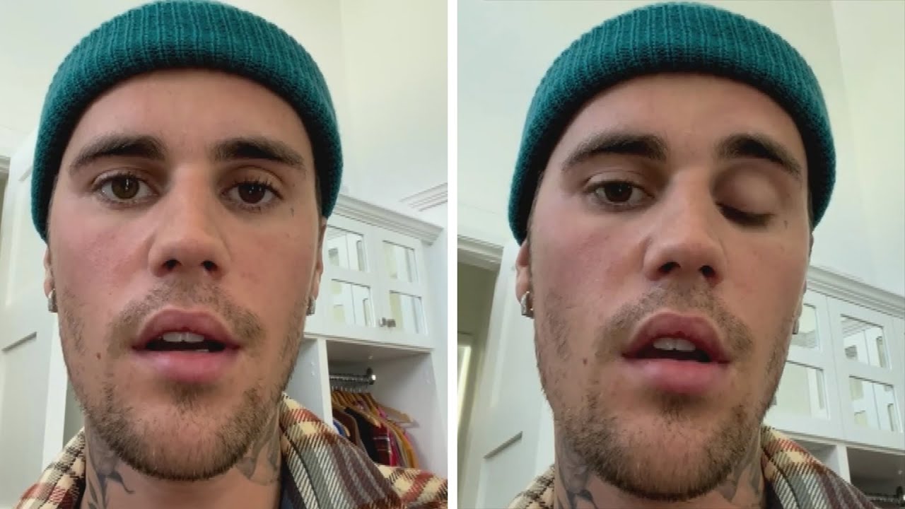 Justin Bieber Reveals His Face Is PARALYZED