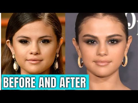 Selena Gomez: Plastic Surgery (2020) & Beauty.