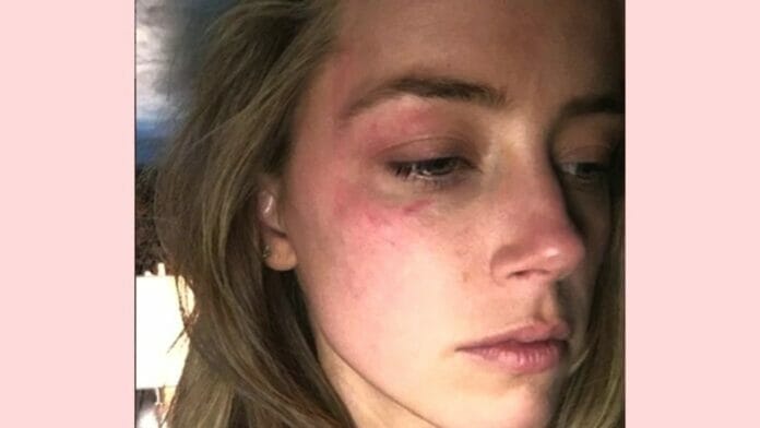 The photo Amber used to prove Johnny had thrown a phone at her face