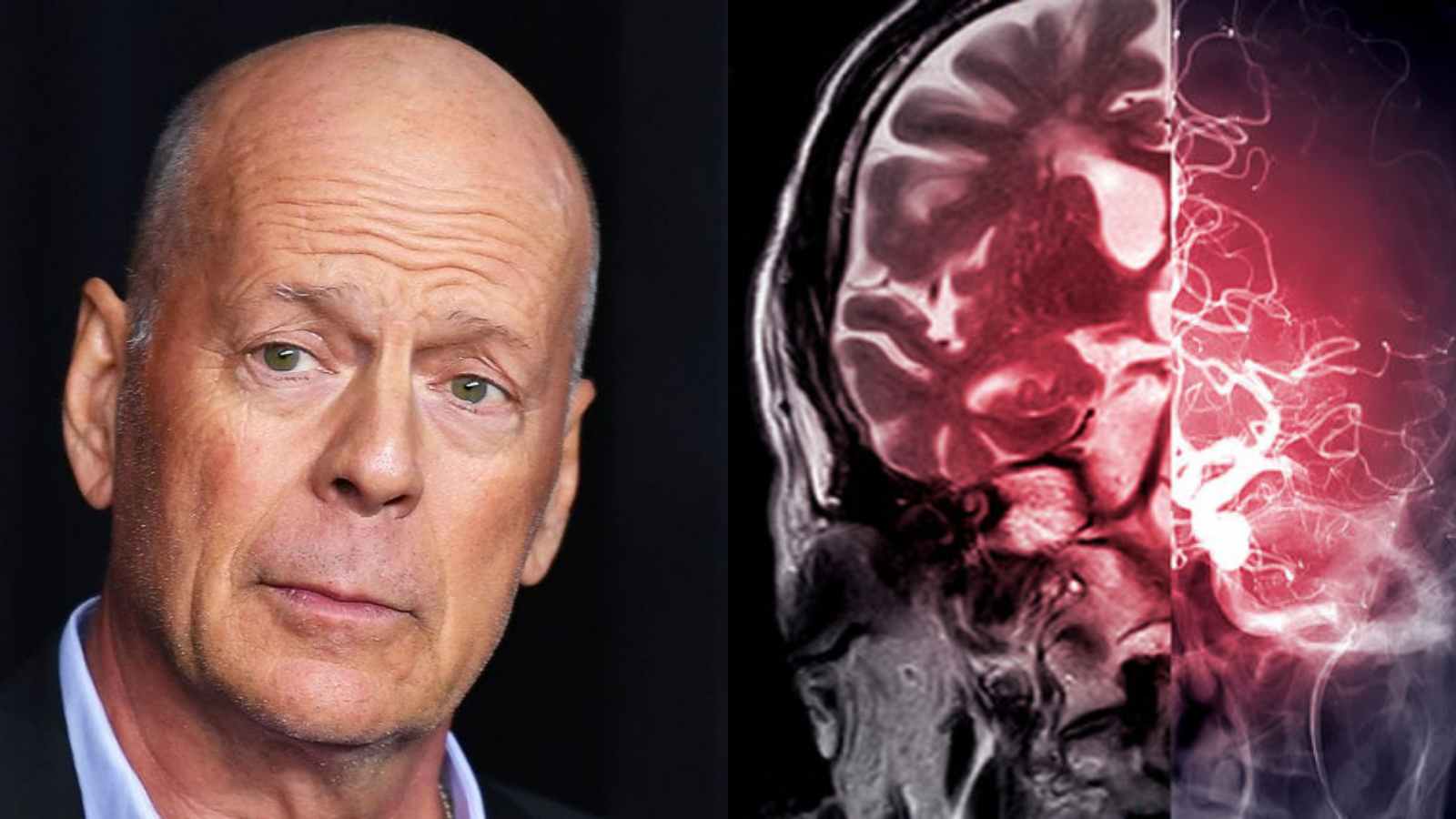 Bruce Willis diagnosed with aphasia